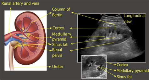 Ultrasonography of the Kidney: A Pictorial Review .